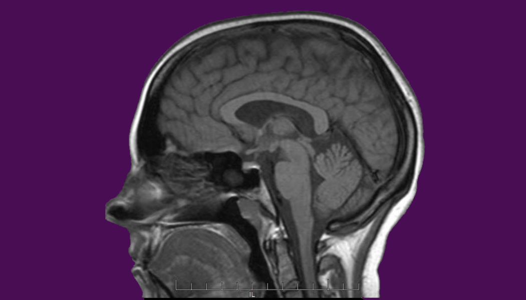 Photo of Cassidy's brain in a sagittal MRI scan, but with purple background.